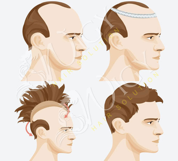 Non-Surgical Hair Replacement Service